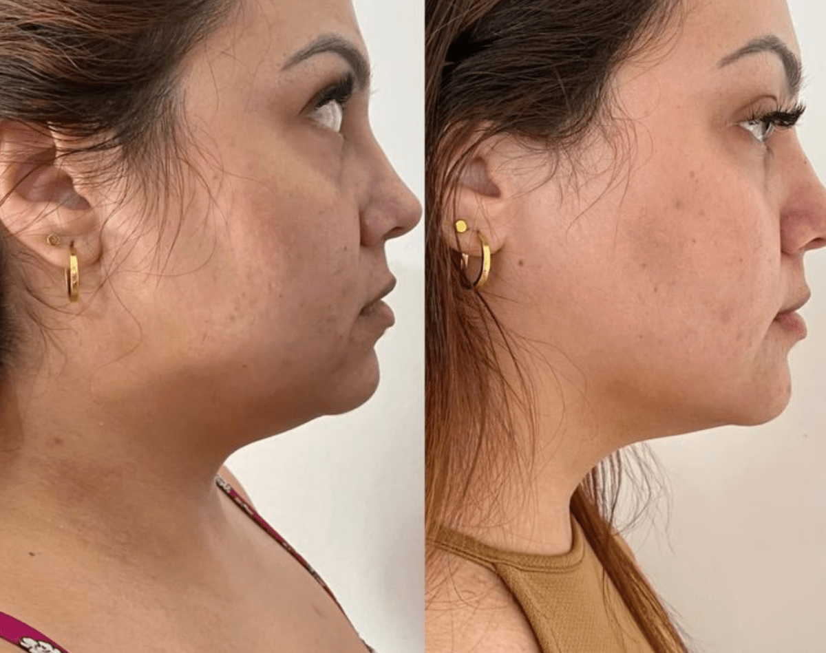 3 - in - 1 Face and Neck Massager - Dermovia™