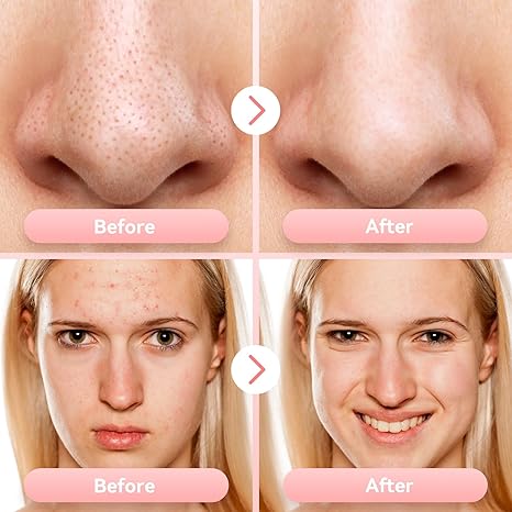 Blackhead Facial Remover - Dermovia™