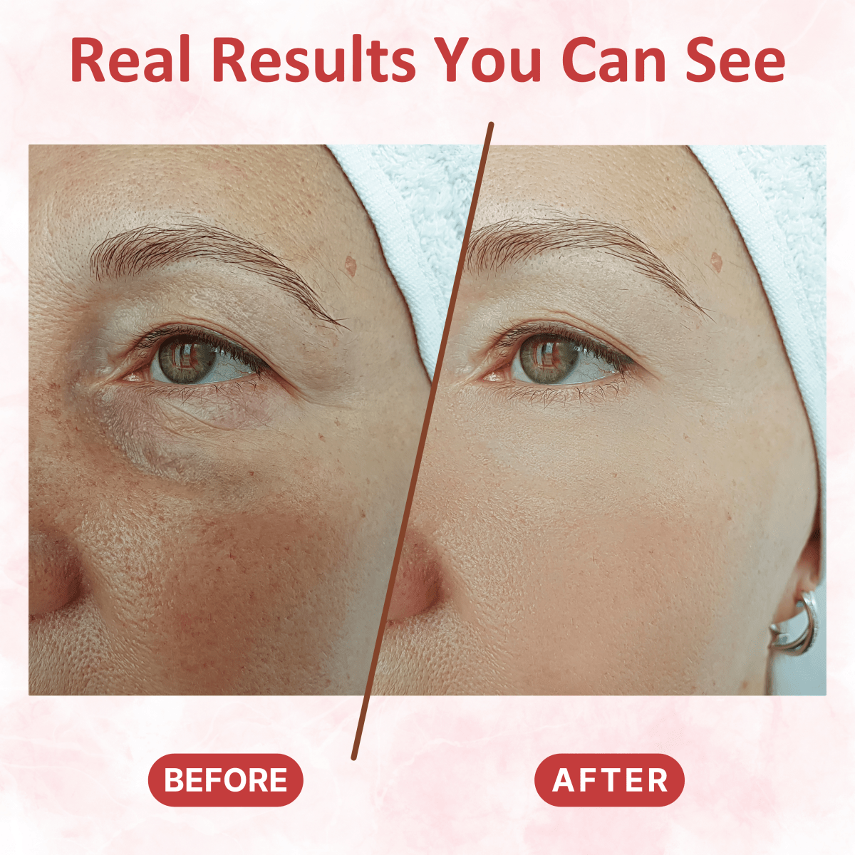 Under Eye Collagen Patches - Dermovia™