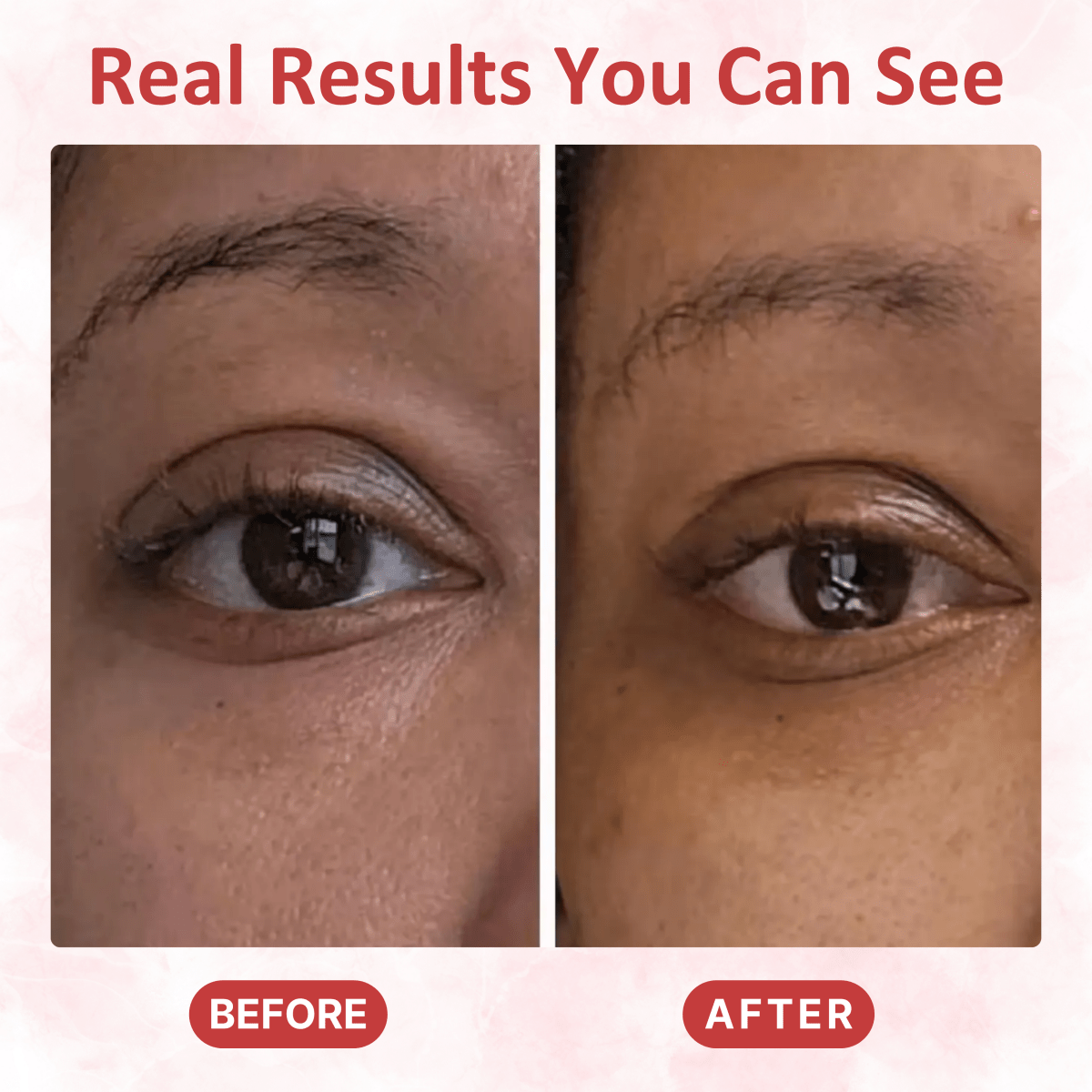 Under Eye Collagen Patches - Dermovia™